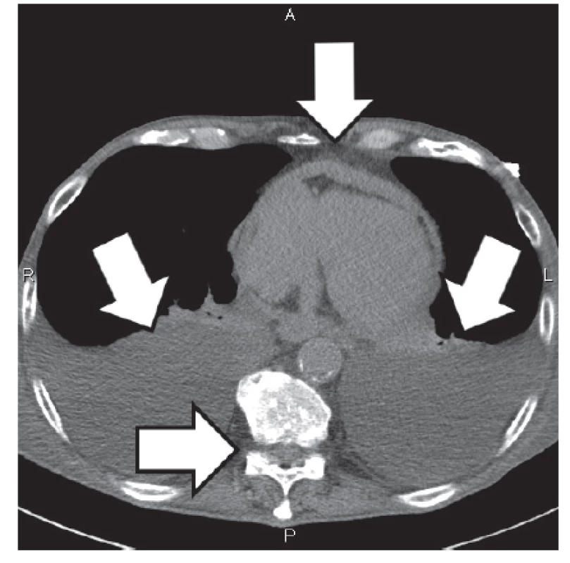 Na snímku CT obraz Masivní pleurální výpotky oboustranně (znázorněno šipkami), kompresivní atelektáza části dolního laloku bilaterálně, perikardiální výpotek (znázorněno šipkou), plicní centrilobulární emfyzém, postspecifické změny vlevo v horním laloku bez známek jasné TBC exacerbace, aneurysma v aortálním oblouku, ateroskleróza aorty. Městnání v malém oběhu bez známek plicního edému. Metastatický proces jater a skeletu (znázorněno šipkou), aerobilie.
Fig. 2. CT scan
Bilateral massive pleural effusion (indicated by arrows), bilateral lower lobe compressive atelectasis, pericardial effusion (see the arrow), centrilobular pulmonary emphysema, postspecific changes in the left upper lobe, no clear signs of exacerbation of tuberculosis, aortic arch aneurysm, and aortic atherosclerosis. Congestion in small circulation with no signs of pulmonary
oedema. Liver and skeletal metastases (see the arrow), aerobilia.