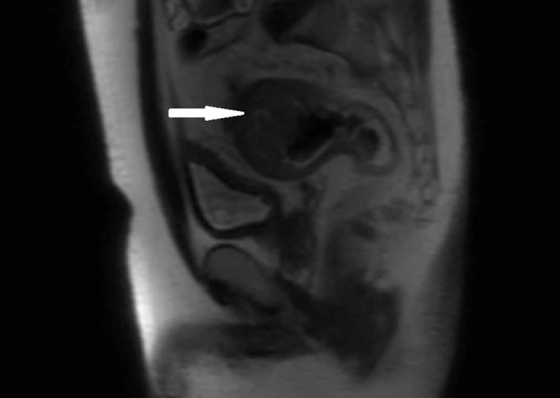 NMR vyšetření, sagitální skeny: tumor rektosigmatu (bílá šipka) dobře oddělený od močového měchýře – indikace k prosté resekci rektosigmatu.
Fig. 3: MRI scan: tumour of the rectosigmoid (white arrow), without invasion into the urinary bladder – indication for a simple large bowel resection.