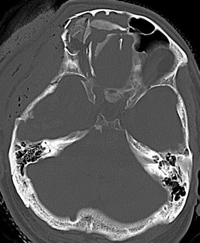 Tříštivá zlomenina baze přední jámy lební na CT snímku