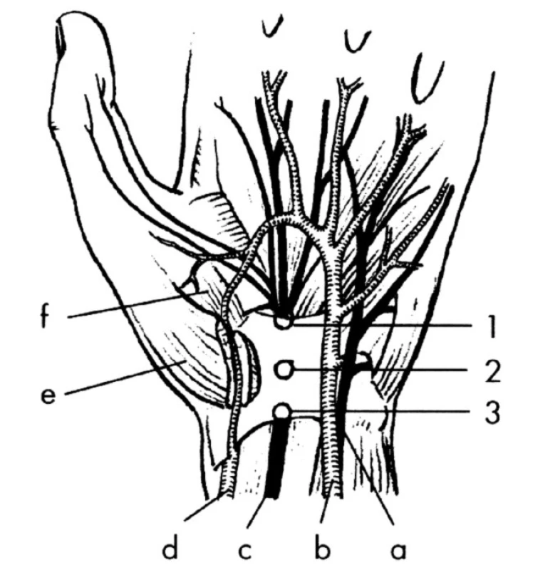 Topografické schéma karpálního tunelu
Úžiny: 1, 2, 3 (v různých místech pod ligamentum carpi transversum).
a – n. ulnaris,
b – arteria ulnaris,
c – n. medianus,
d – arteria radialis,
e – m. abductor pollicis brevis,
f – m. opponens pollicis.