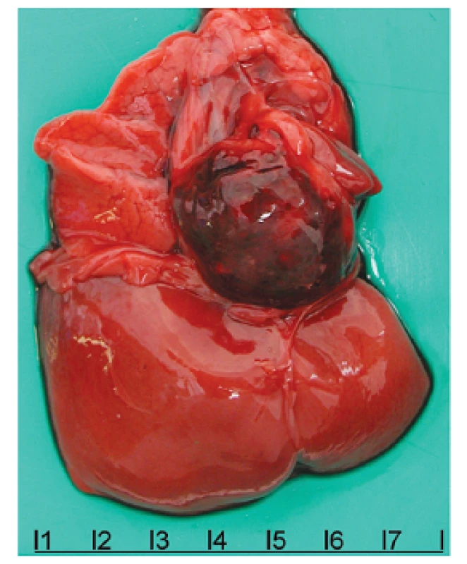 Intrapericardial teratoma. The tumor is localized anterior to the heart, which together with the left lung, are displaced posteriorly and partly covered by the tumor. Scale in cm.
