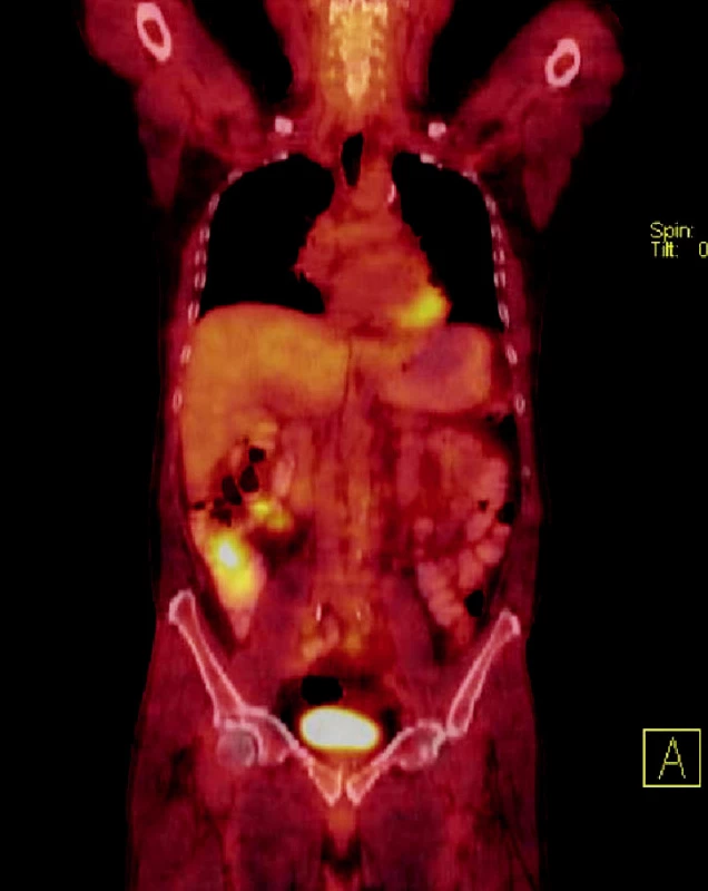 Scan PET/CT vyšetření – vysoká aktivita izotopu patrna v oblasti céka, aktivita v rektu překryta močovým měchýřem
Fig. 1. PET/CT scan shows the high isotope activity in caecal region, the activity isotope activity in rectal region is hidden by urinary bladder