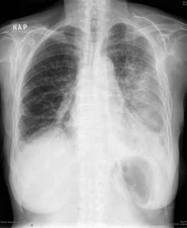 RTG hrudníku: kryptogenní organizující se pneumonie