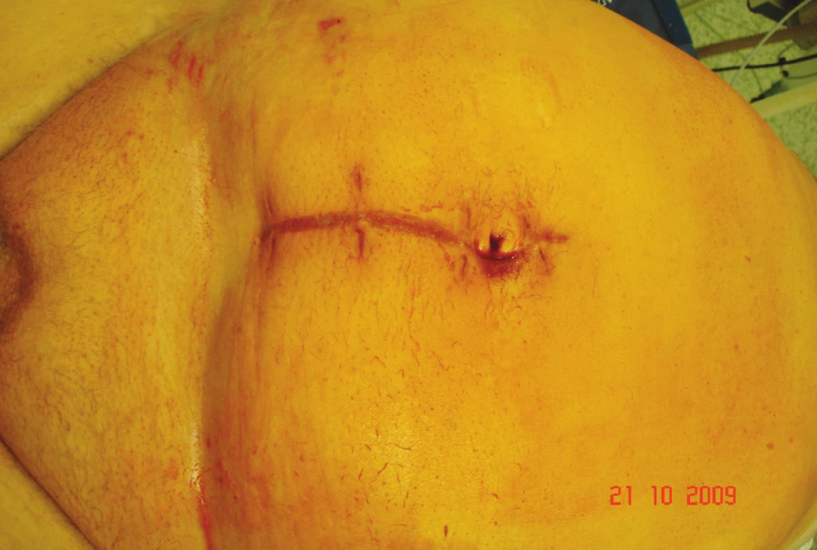 Jizva po první operaci
Fig. 5. A scar following the first procedure