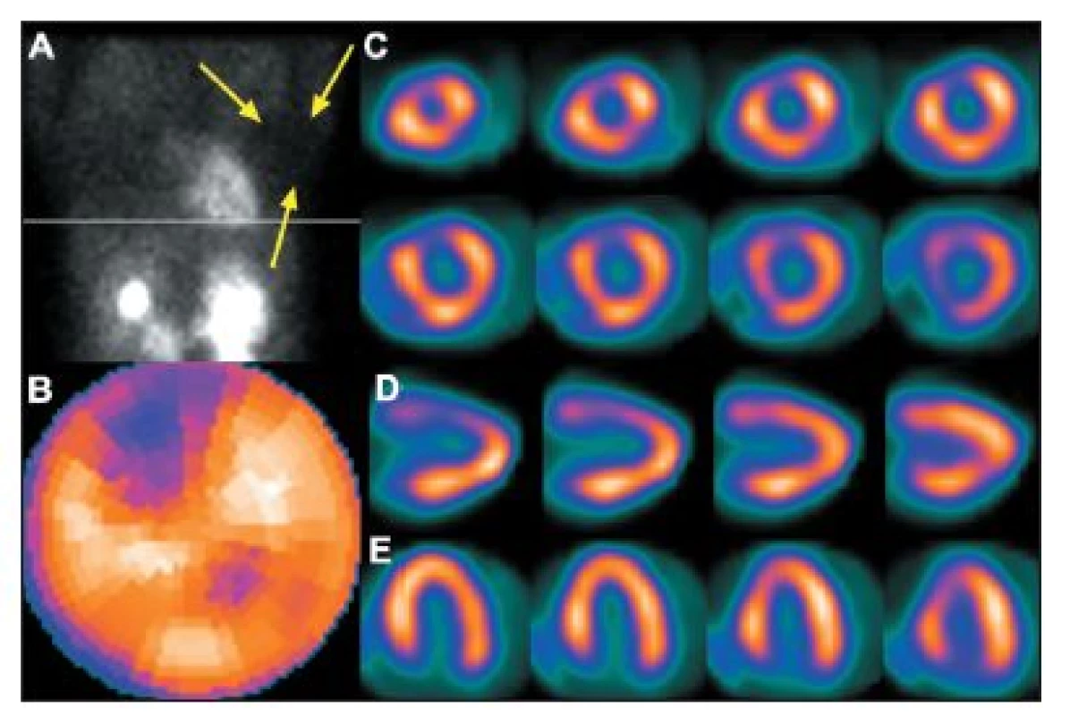 Vyšetření u pacientky s prsními implantáty. Na vybraném snímku z tomografického záznamu (A) je zřetelné zeslabení záření implantátem (šipky), které způsobuje arteficiální defekt perfuze na přední stěně – zobrazeno na polární mapě (B) a vybraných tomografických řezech (C – SA, D – VLA, 
E – HLA).