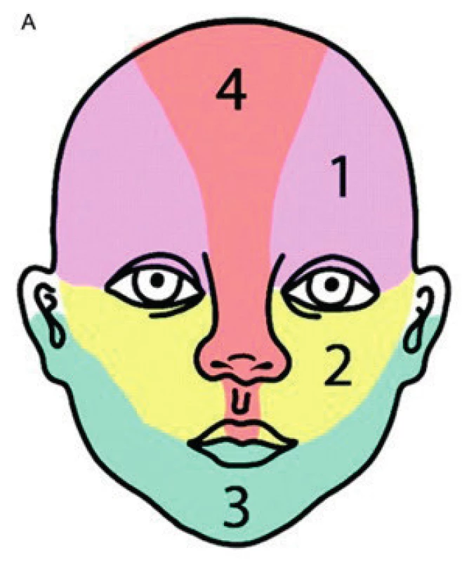 Části obličeje při postižení segmentálním IH. 1 – frontotemporální, 2 – maxilární, 
3 – mandibulární, 4 – frontonazální
Fig. 1. Areas of face involvement by segmental hemangioma. 1 – frontotemporal, 2 – maxillar, 
3 – mandibullar, 4 – frontonasal