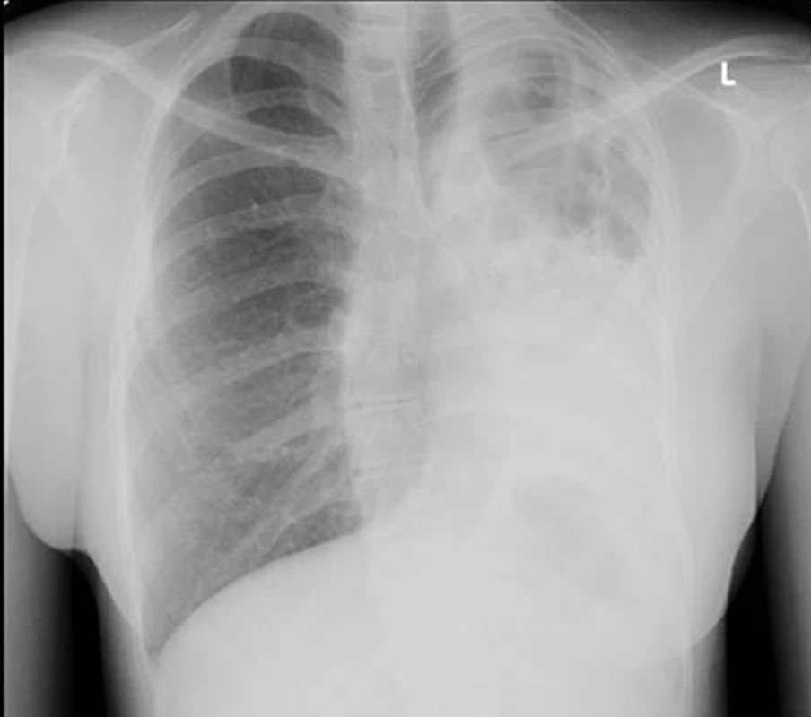 Zadopřední skiagram nemocné s bronchiektáziemi na podkladě vrozené vývojové vady levé plíce