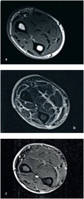 MR svalů předloktí při stanovení diagnózy (a, b) a po 3 měsících terapie (c).
V T1 váženém nativním obraze je zvýrazněn pouze signál kožní vrstvy, která je současně i rozšířená, svaly mají normální strukturu (a). V T2 obraze postkontrastně je v téže oblasti patrné zvýraznění fascií, intramuskulárních sept a kůže (b). Na třetím snímku (c) z kontrolního vyšetření po terapii (T2 obraz, postkontrastně) je patrná kompletní regrese zánětlivých změn.