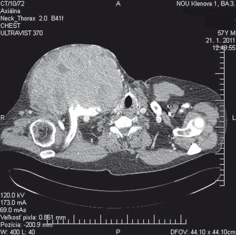 A staging thorax and abdomen CT scan verified a large encapsulated tumor 17 × 11 × 13 cm.