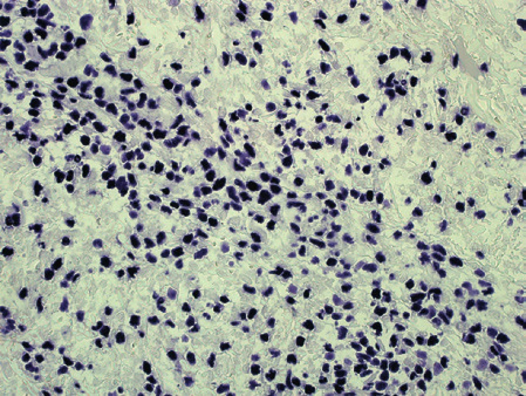 Pacient 5. Průkaz EBER v jádrech nádorových lymfocytů.
Chromogenní &lt;em&gt;in situ&lt;/em&gt; hybridizace – vizualizace vazby sond tetrazoliovou modří (původní zvětšení 100x).