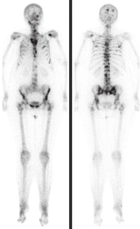 Vstupní kostní scintigrafie prokázala dvě ložiska patologicky zvýšené kostní přestavby v lebce a v 5. žebru vpravo.