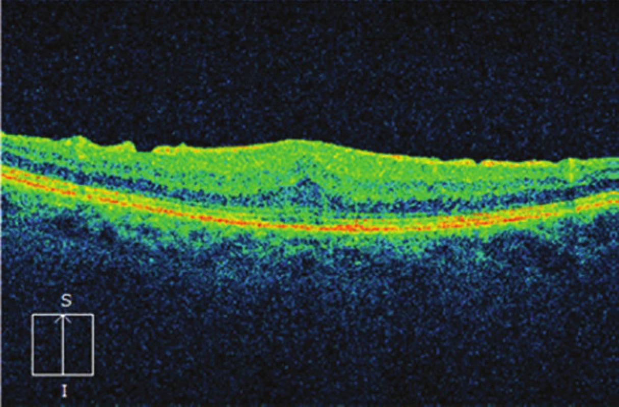 Nález makuly na OCT 3 měsíce po operaci: ústup edému, úprava linearity retinálních vrstev