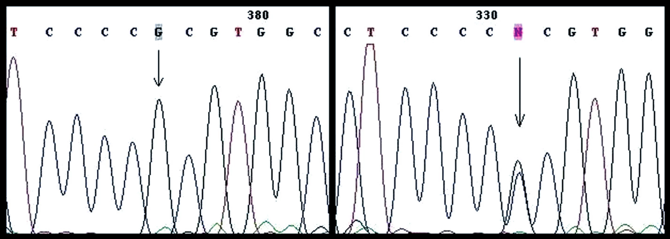 Polymorfizmus CCC/CGC Pro72Arg v exóne 4 (vľavo homozygotný typ, vpravo heterozygotný typ)