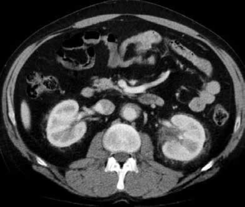 Postkontrastní CT vyšetření břicha, axiální rovina
Cirkulárně obkružující infiltrát kolem břišní aorty s přestupem změn na odstupy renálních tepen.