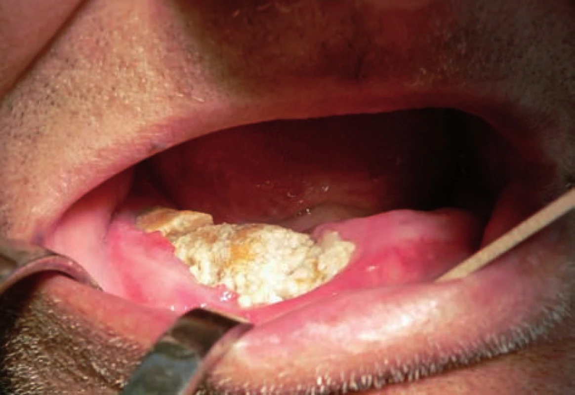 Klinický obraz osteonekrózy mandibuly s patrnou patologickou zlomeninou u pacienta s mnohočetným myelomem, který užíval 9 měsíců klodronát a 25 měsíců ibandronát perorálně. Stav vznikl po extrakci zubu 43.