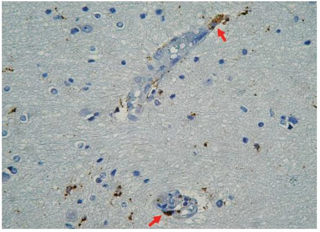 CD68 imunopozitivita v basálních gangliích mozku. Aktivace mikroglie je patrná mezi svazky bílé hmoty i perivaskulárně (označeno šipkou). Pozorujeme i pericelulární edém. Zvětšení 200x.