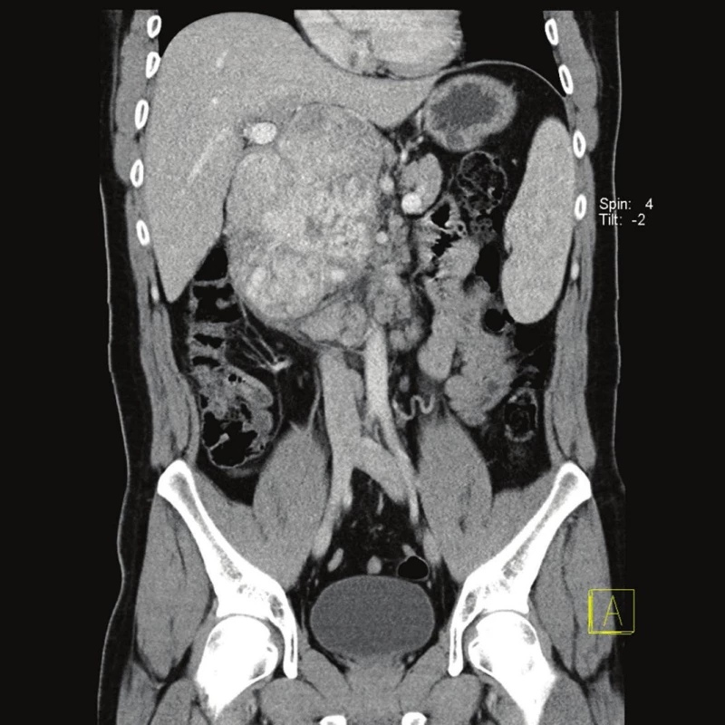 CT obraz tumoru retroperitonea – koronární řez
Fig. 1 : CT image of retroperitoneal tumor (coronal)