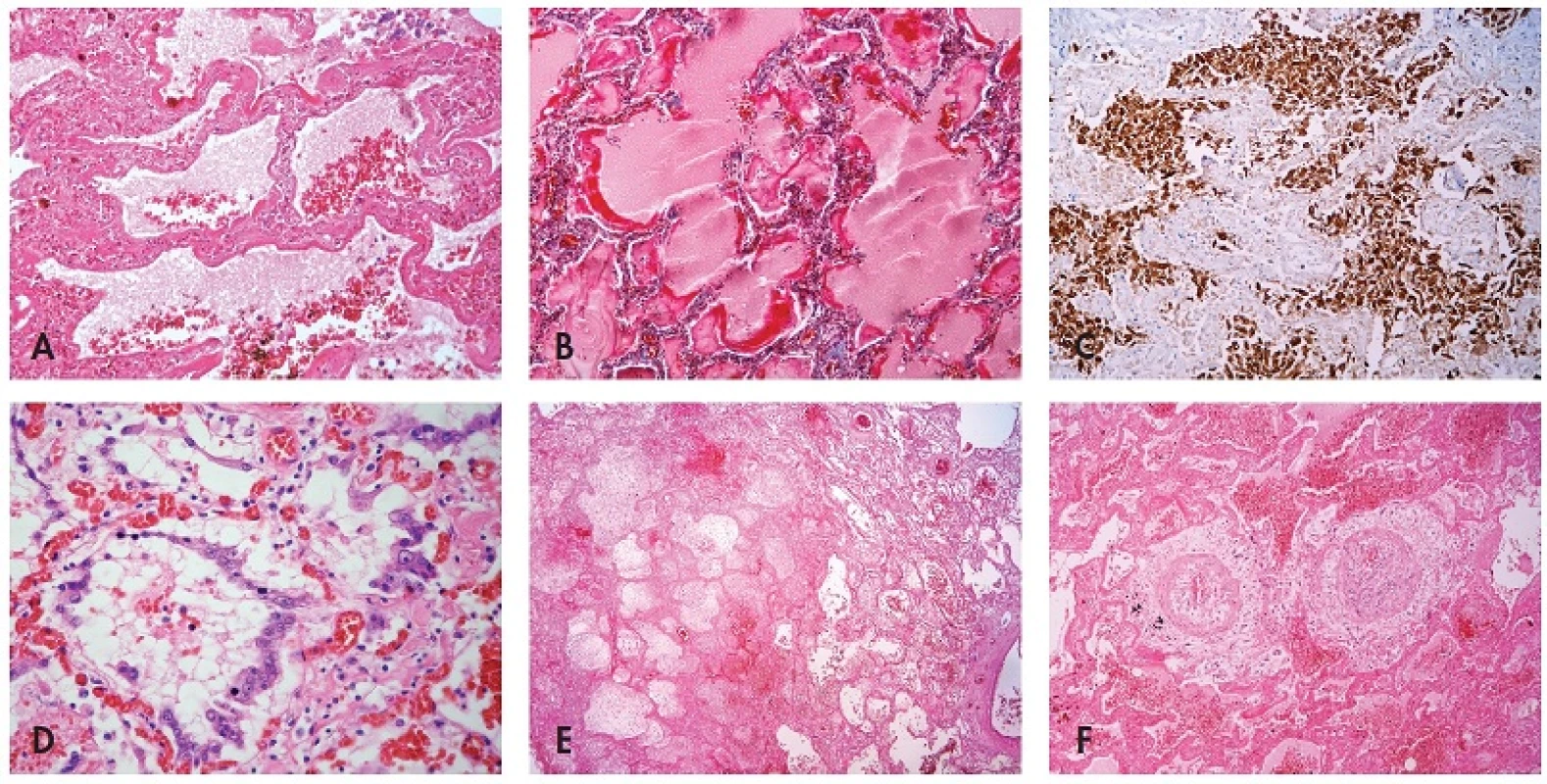 Histological findings associated with influenza A (H1N1) pneumonia: (A) intraalveolar edema with haemorrhages, hyaline membranes lining alveolar spaces, HE, 100x, (B) highlighted hyaline membranes in Masson’s trichrome, 100x, (C) expression of pancytokeratin AE1/AE3 in desquamated pneumocytes, immunohistochemistry, 100x, (D) cytopathic changes of pneumocytes, HE, 200x, (E) necrosis, HE, 40x, (F) atypical acute vasculitis with nearly obturating intimal proliferation, HE, 100x.