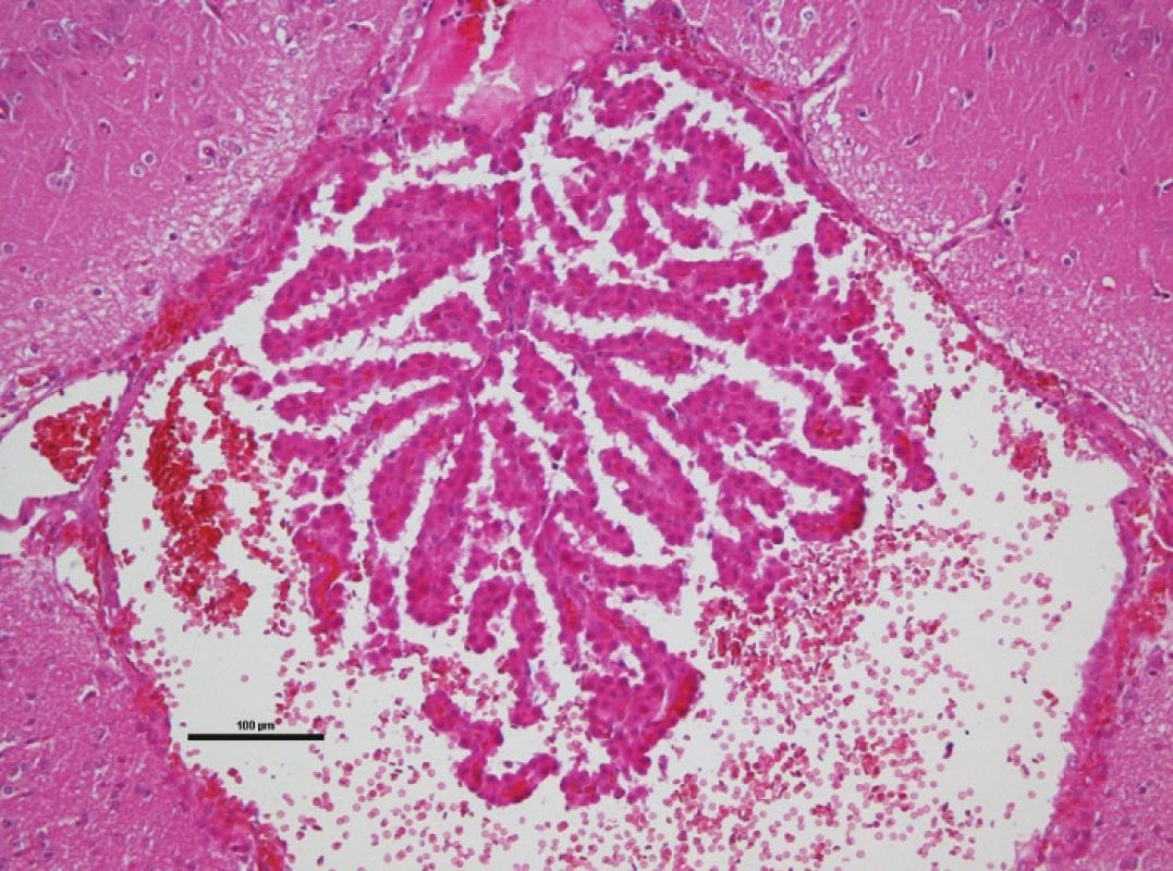 Histologické vyšetření po kraniotraumatu: prokrvácený plexus choroideus
