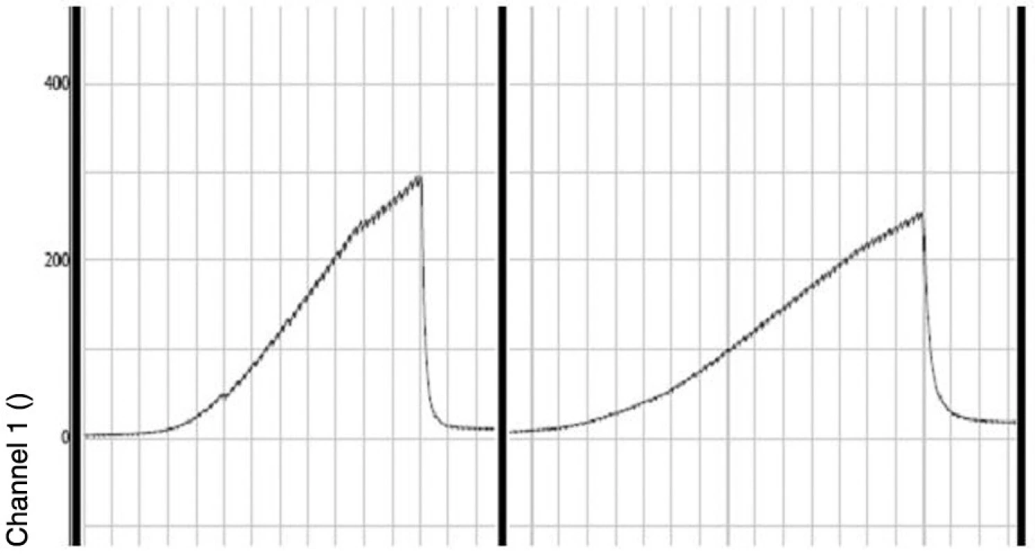 Záznam intraluminálního střevního tlaku v programu Chart 5 při měření pevnosti anastomózy. Prudký pokles tlaku odpovídá okamžiku porušení integrity střevní stěny. První křivka je kontrolním záznamem z oblasti proximálního neoperovaného střeva, druhá křivka je záznamem z oblasti anastomózy.
Fig. 3. The recorded of bursting pressure in the Chart 5 programme in the anastomosis resistance assessment anastomosis strenght. The rapid pressure drop corresponds with a moment when the intestinal wall integrity was flawed. The first curve is a control record from the unoperated proximal intestine, the second curve recorded the anastomotic region.