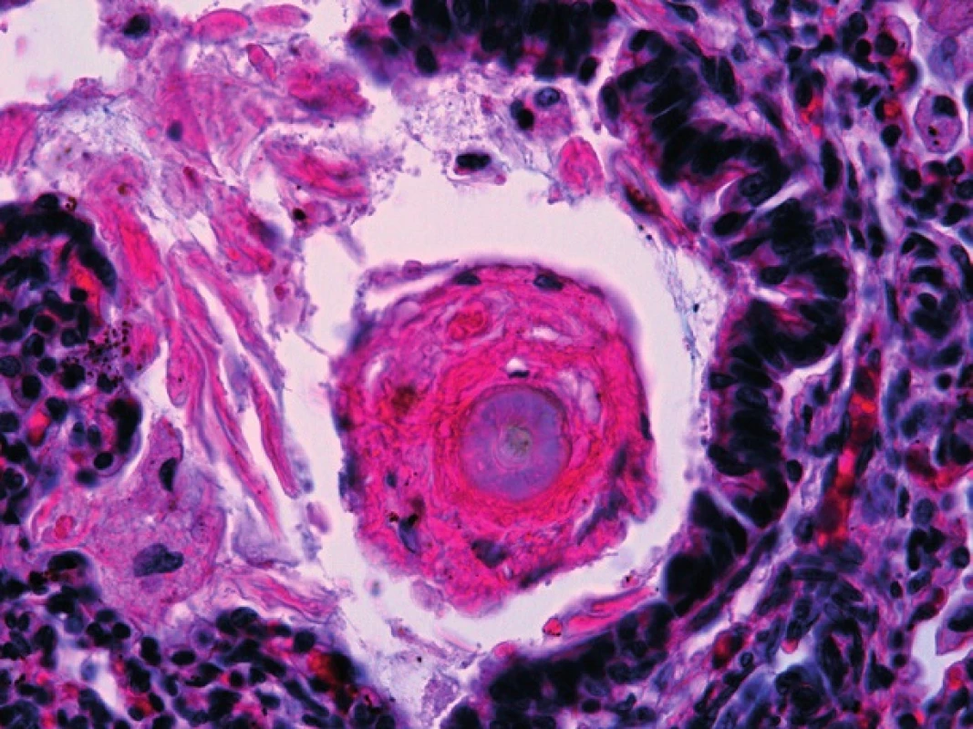 Pľúcne „hassalloidné“ teliesko s epitelovou folikulárnou štruktúrou kože zachytenou v bronchu (HE, 240x).