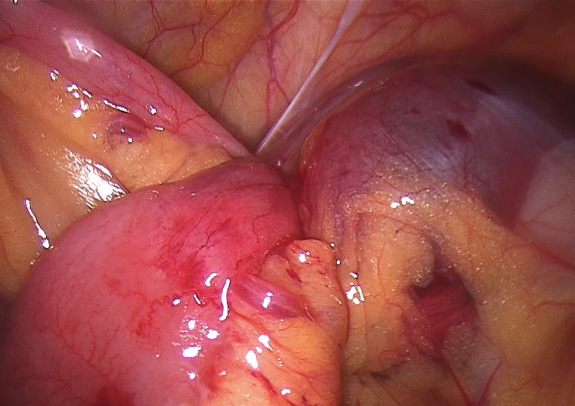 Laparoskopický obraz dilatovaných kliček tenkého střeva
Fig. 3: Laparoscopic image of dilated small intestine loops