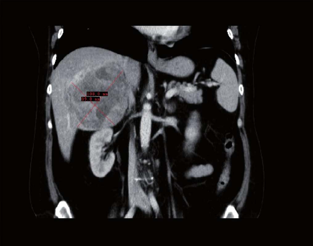 CT vyšetření v dubnu 2010, největší rozměr tumoru jater 108 x 99mm (frontální řez)