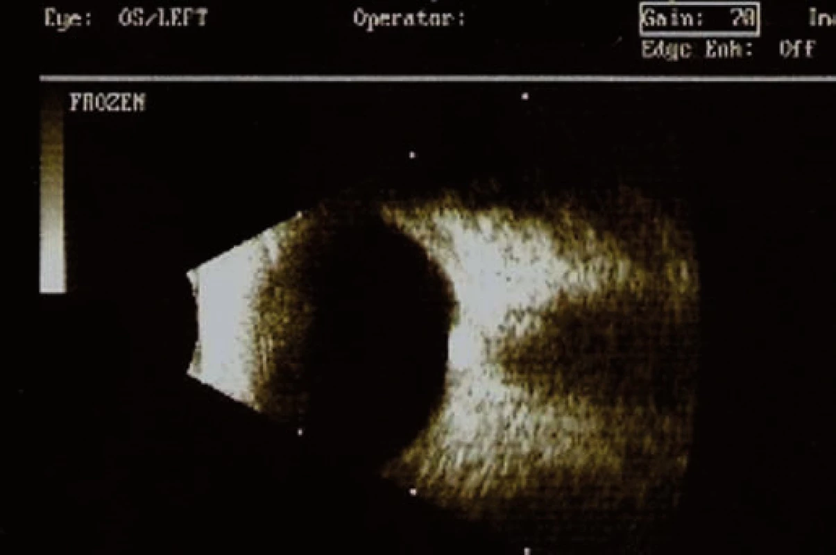 B-scan ultrazvukové vyšetrenie ľavého oka (pacient č. 1).
Na úrovni TZN viditeľné rovnaké hyperechogénne útvary – drúzy.