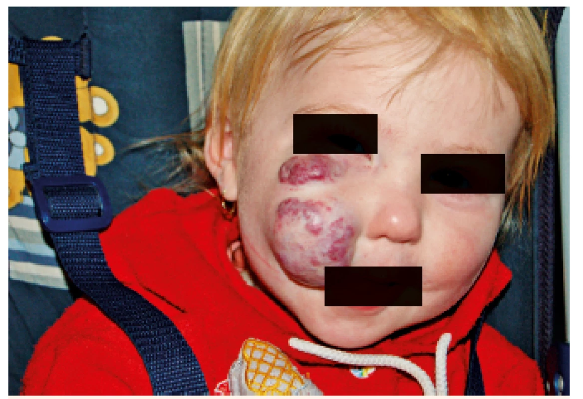 Reziduum neléčeného hemangiomu u 2letého dítěte.
Fig. 7. Residue of untreated hemangioma in two years old child.