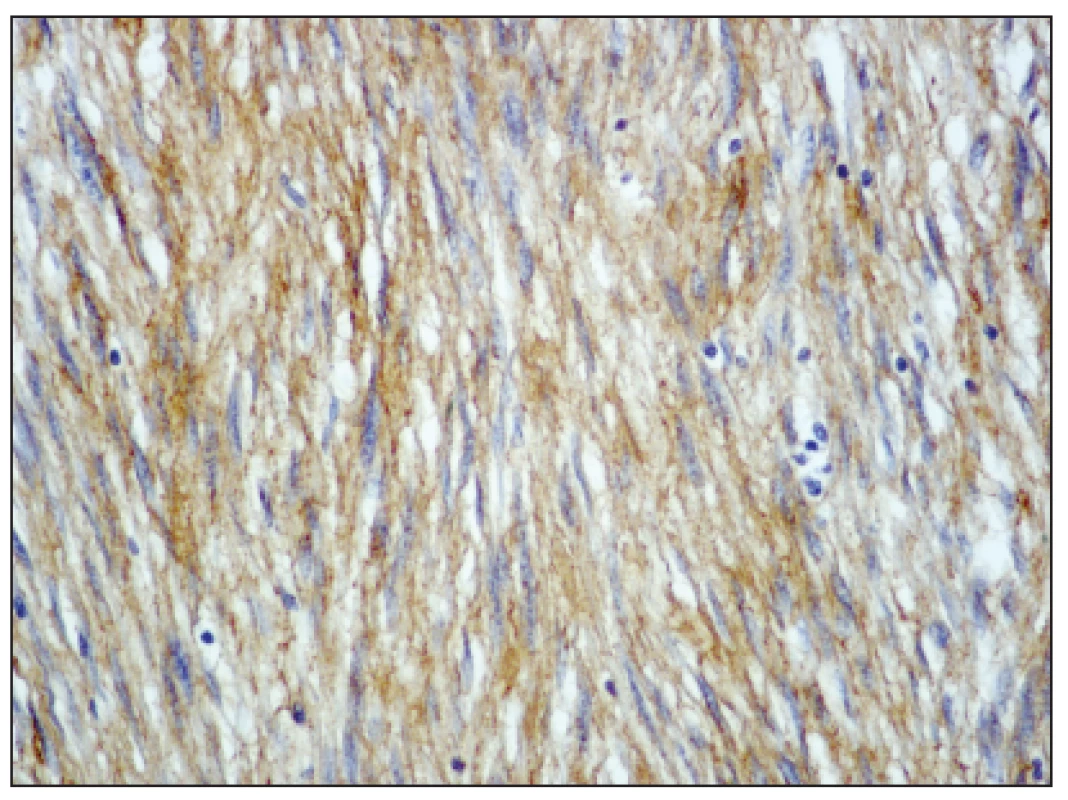 Nádorové buňky exprimují c-kit (CD117), zvětšeno 200x 
Fig. 3. The tumor cells expressing c-kit (CD117), enlargement 200x