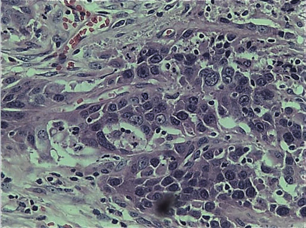 Microphotograph of the excised specimen showed large polygonal cells with round, hyperchromatic pleomorphic nuclei forming nests and occasional glandular structure (H &amp; E stain).