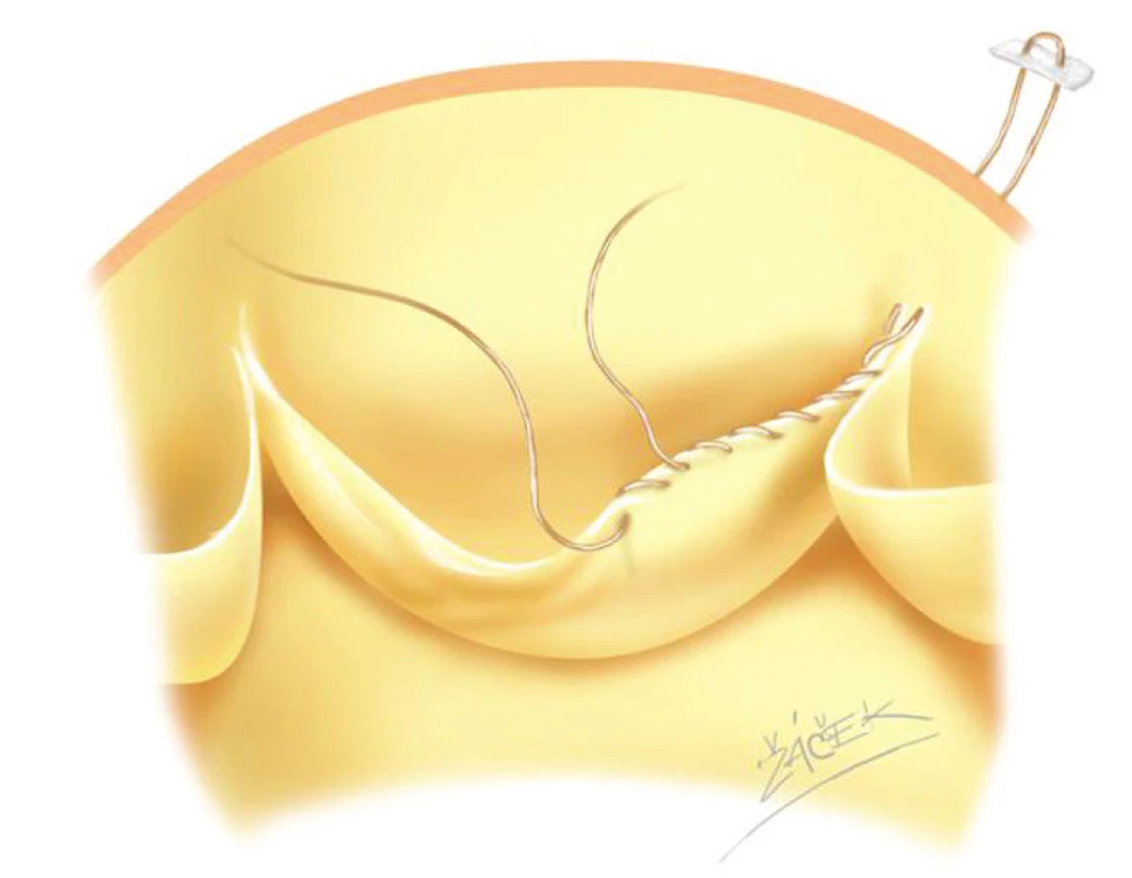 Vyztužení okraje postiženého cípu aortální chlopně pomocí goretexového vlákna.