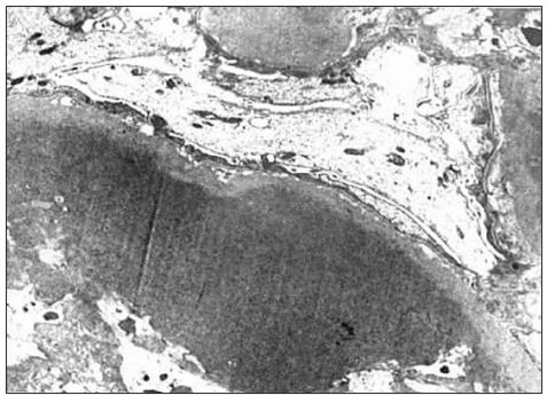 Pri elektrónovej mikroskopii boli v 3. glomerule veľké depozity homogénneho materiálu (hyalín).