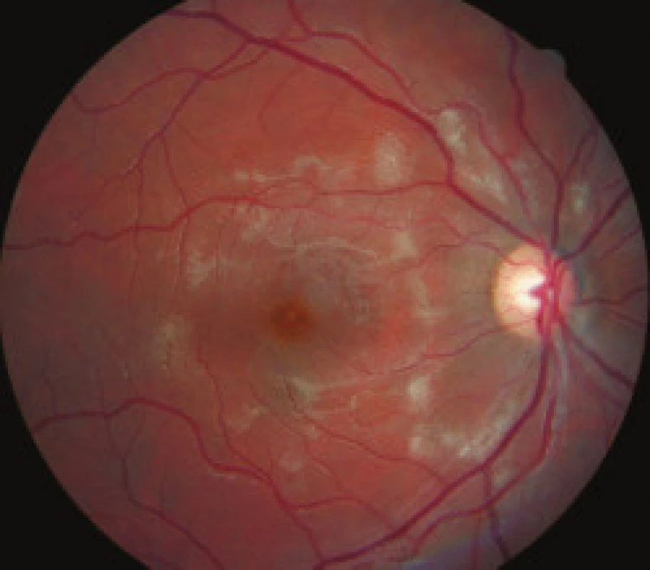 Pravé oko, mesiac po zahájení liečby, výrazné vstrebávanie belavých ložísk na sietnici.
