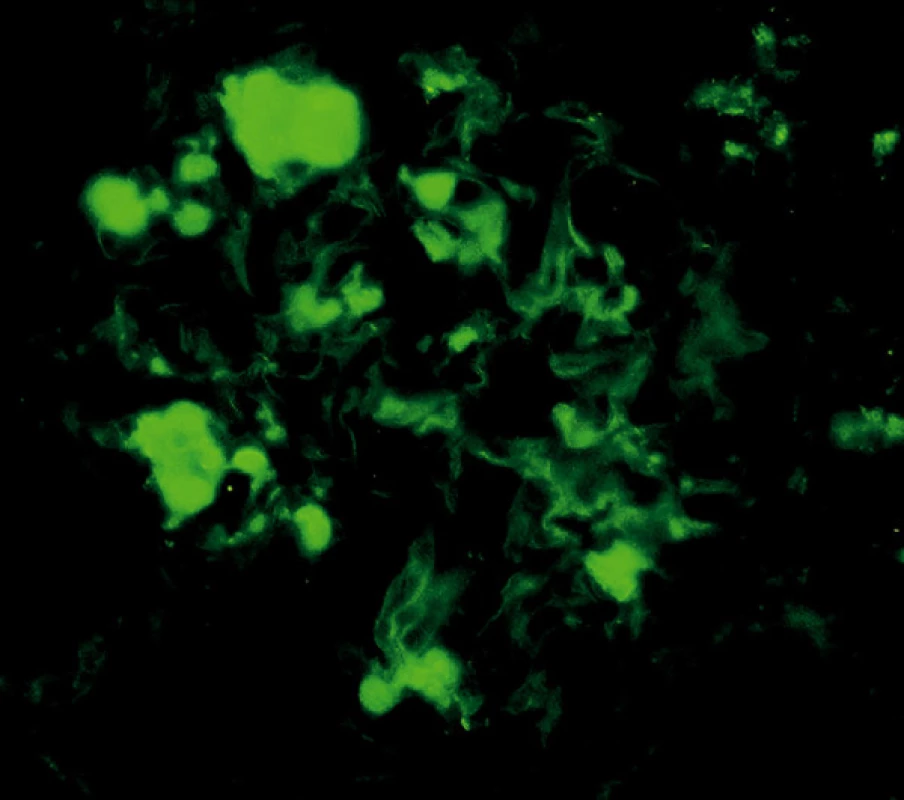 Imunofluorescenční průkaz AA amyloidu – plošné pozitivity v glomerulu (objektiv 40krát)