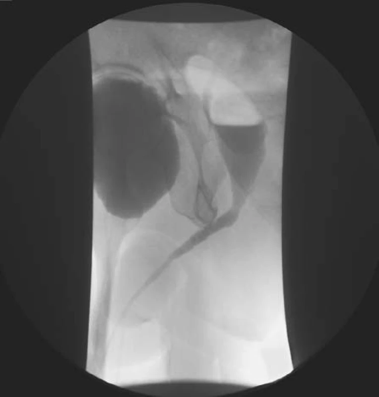 Uretrocystografie – při mikci se kontrastní látkou plní ohraničená dutina odpovídající ingvinoskrotální herniaci močového měchýře
Fig. 4. Urethrocystography – massive inguino-scrotal herniation of bladder filled with contrast agent during voiding phase
