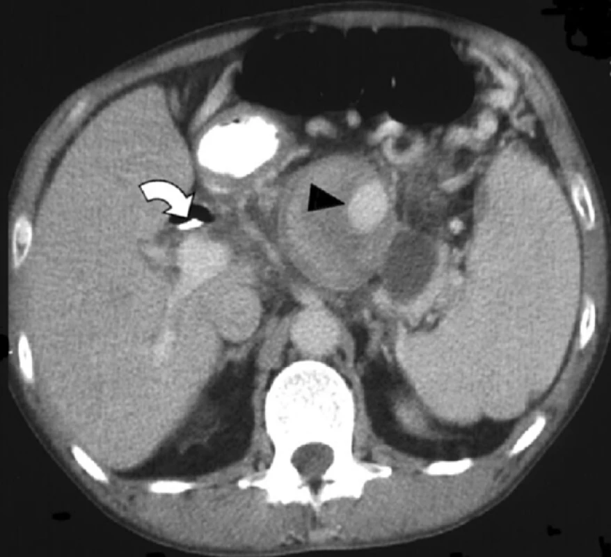 Postkontrastní CT vyšetření ukazuje oválné, ohraničené pseudoaneuryzma (šipka) uvnitř pseudocysty lokalizované v těle pankreatu. Plastikový drén v hepato-choledochu (ohnutá šipka).
Další pseudocysta v oblasti kaudy pankreatu.