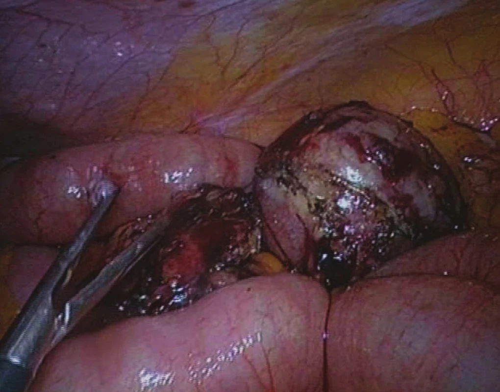 Nádor mezenteria před extrakcí minilaparotomií
Fig. 6: Mesenteric tumour before extraction by minilaparotomy