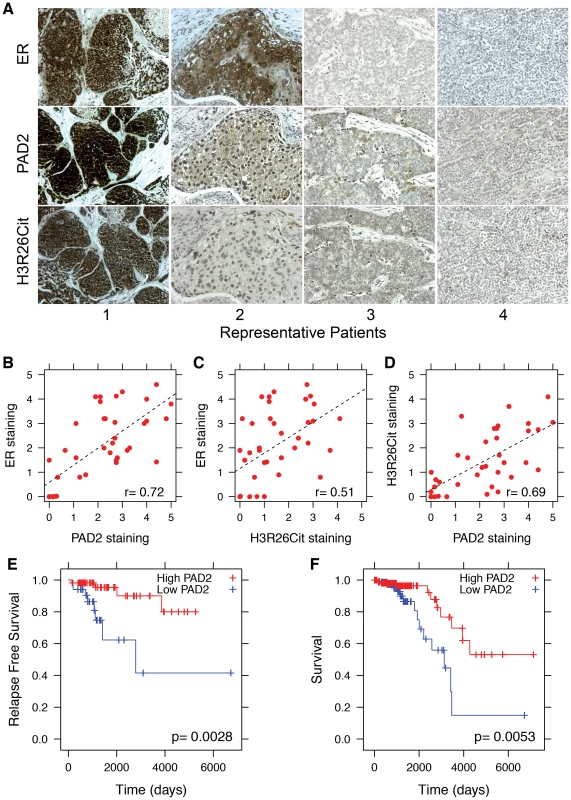 PAD2 expression correlates with breast cancer survival.