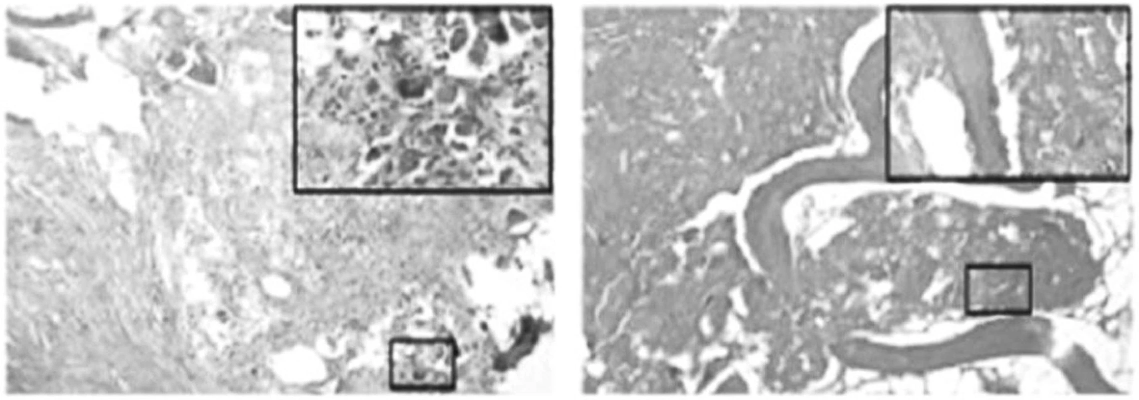 Výrazně vyšší zastoupení osteoblastů při barvení hematoxylin-eosin ve vzorku tkáně pacienta po aplikaci ESWT /obrázek vlevo/ oproti kontrolám /vpravo/.