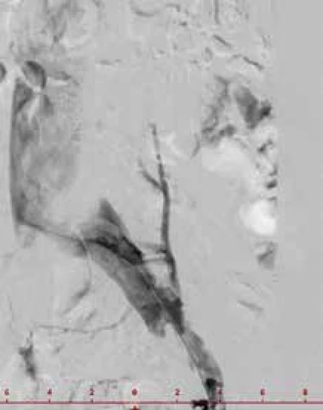 Angiografický obraz Mayova-Thurnerova syndromu.