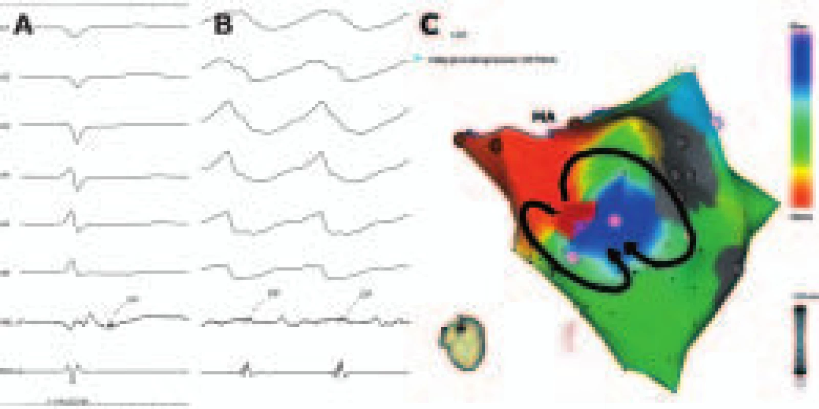 Anatomická rekonstrukce levé komory a mapování při sinusovém rytmu a při běžící SMKT mechanizmu makroreentry. 