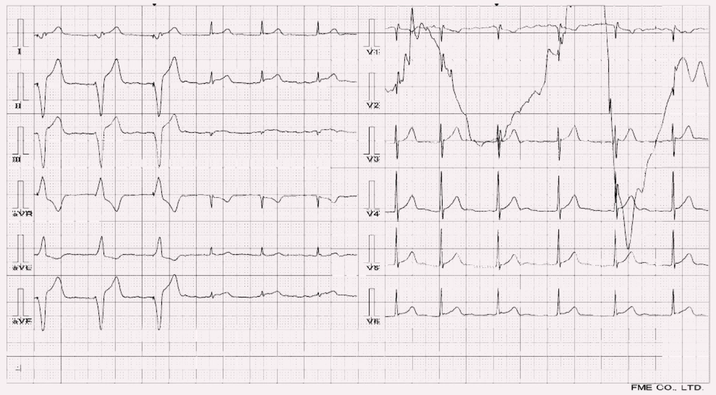 Akutní infarkt myokardu dolní stěny u pacienta s kardiostimulátorem (První tři QRS v končetinových svodech jsou stimulované komplexy, následuje akce s vlastním převodem na komory a elevacemi II, aVF, V5-6).