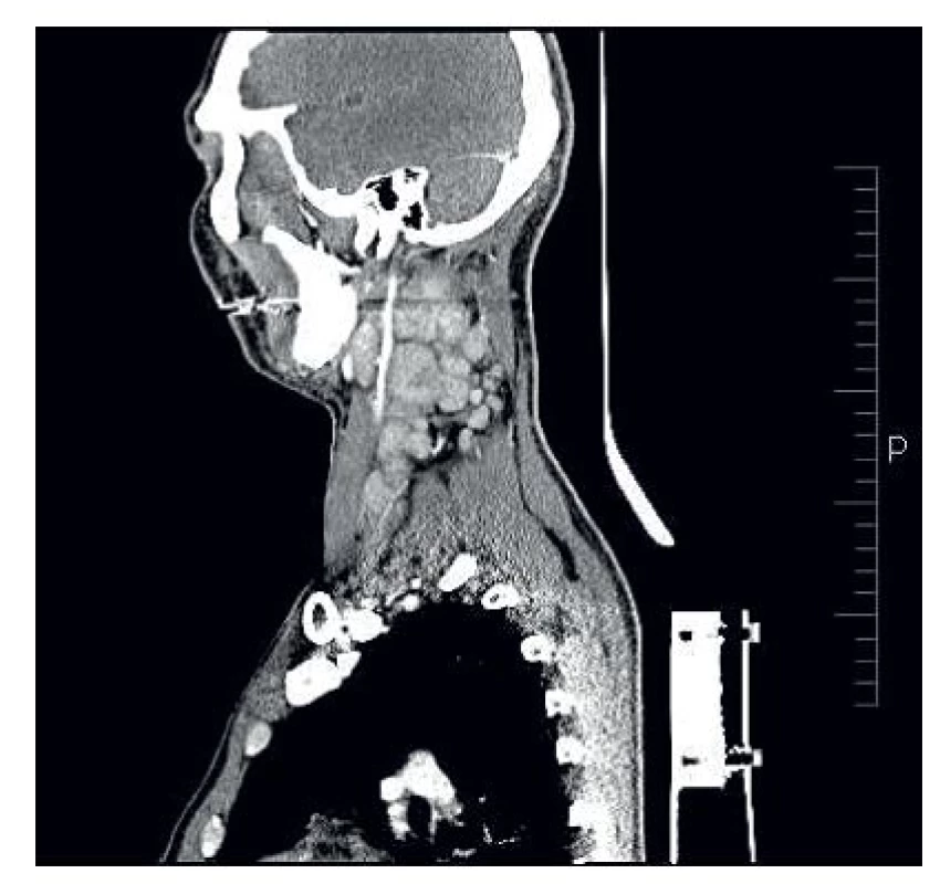 CT nález – zvětšené lymfatické uzliny na krku a periklavikulárně vlevo.