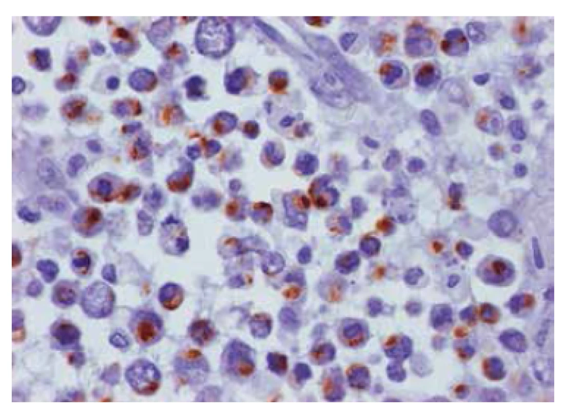 Imunohistochemické vyšetření na desmin (myogenní marker): některé buňky jeví intracytopazmatickou/ paranukleární pozitivitu (hnědě), jde tedy o sarkom s parciální myogenní diferenciací, 400x.