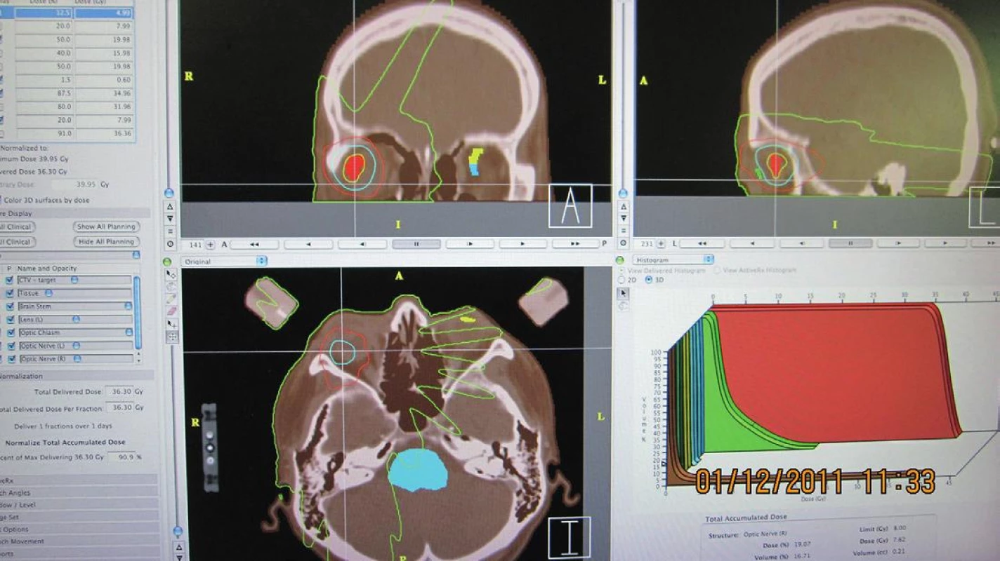Stereotaktický rádiochirurgický plán pacienta s malígnym melanómom choroidey, grafické naznačenie DVH (Dose Volume Histogram)