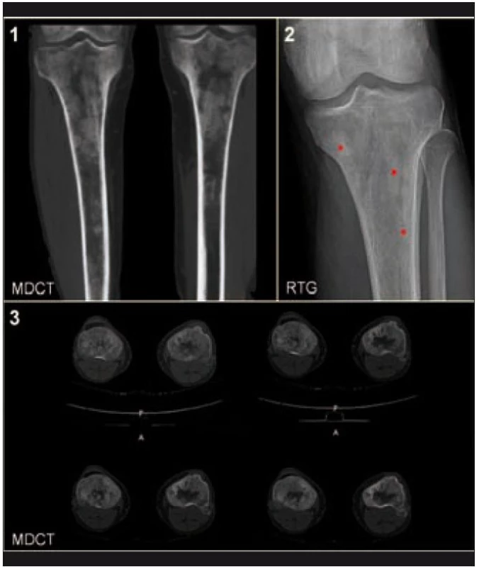 Zobrazení tibie metodou konvenční radiografie (RTG) a metodou multidetektorové výpočetní tomografie (MDCT).

(1) MDCT, MIP rekonstrukce v koronární rovině: zřetelná osteoporotická struktura s osteosklerotickými ložisky.

(2) RTG: tečkami jsou označena osteosklerotická ložiska.

(3) MDCT, axiální rovina: patrné je zesílení hydroxyapatitových struktur kortikalis a spongiózy.