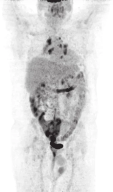 Pacient č.2, VI/2013 PET/CT (MIP).