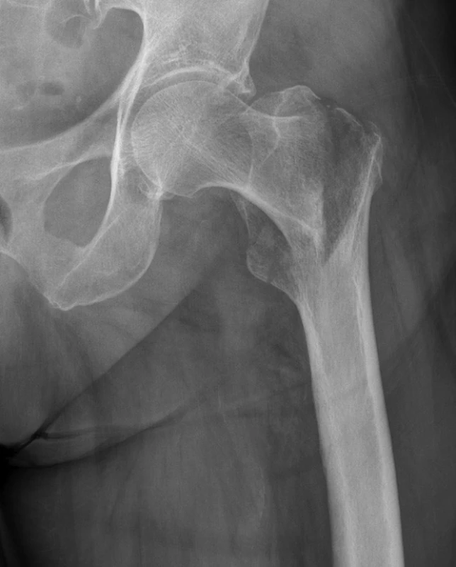 Pertrochanterická zlomenina horního konce stehenní kosti s dislokací fragmentů do varozity