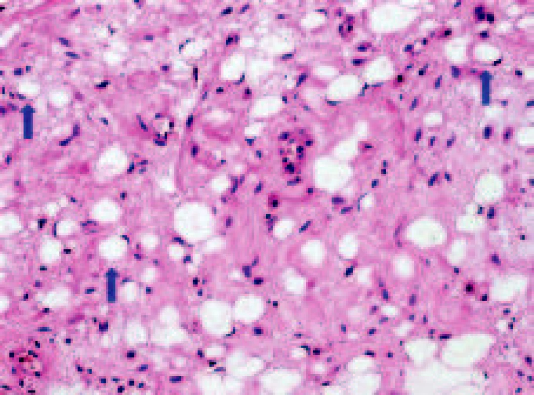 Typická mikrostruktura atypického lipomu s vyzrálými buňkami s objemnými tukovými vakuolami (signet-ring-like buňky;modré šipky) a s proliferujícími nádorovými elementy s malými vakuolami (H.E.; zvětšeno 50x).